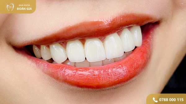 Răng sứ cao cấp