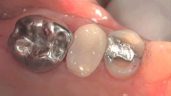 Vật liệu trám răng Amalgam
