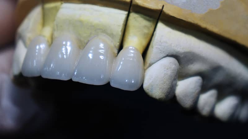 Làm răng sứ thẩm mỹ có đau không?