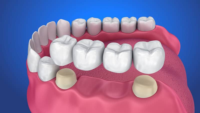 Trồng răng sứ thẩm mỹ bằng phương pháp làm cầu răng