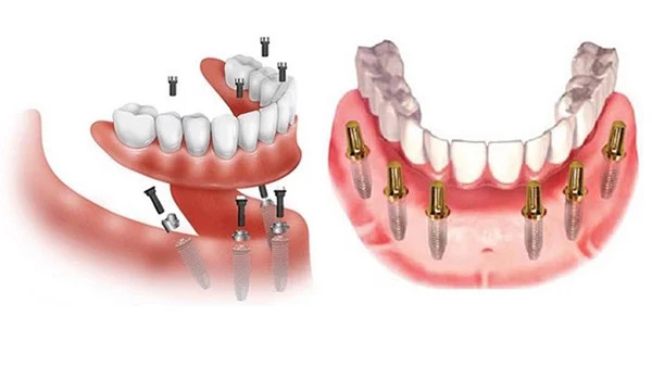 trồng răng implant toàn hàm là gì